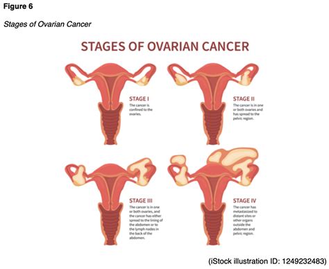 Ovarian Cancer For RNs And LPNs Nursing CE Course NursingCE