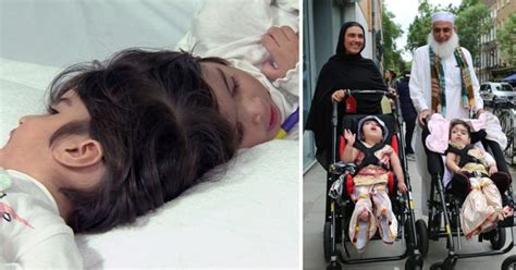 Two Year Old Twins Joined At The Head Separated After 50 Hour Surgery