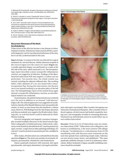 Recurrent Abscesses Of The Neck Scrofuloderma Tuberculosis Of The Skin