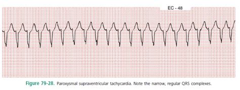 Top psvt abbreviation meanings updated february 2021. CRACKCast E079 - Dysrhythmias - CanadiEM