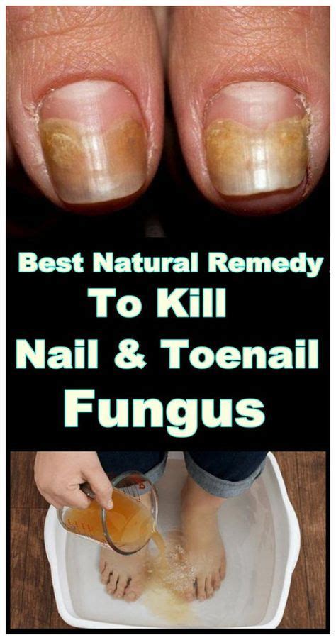 Best Natural Remedy To Kill Nail And Toenail Fungus Toenail Fungus