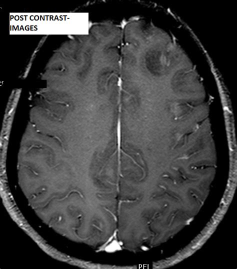 Hiv Encephalopathy Mri Sumers Radiology Blog