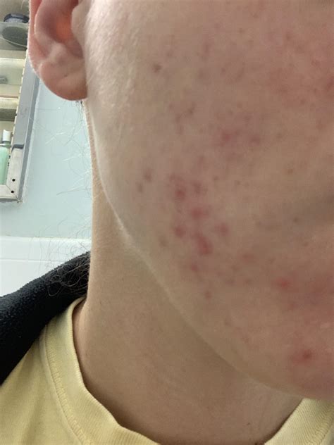 Acne This Cluster Of Small Cysts Will Not Go Away Rskincareaddiction