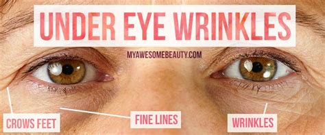 How To Get Rid Of Under Eye Wrinkles Fast And Safely