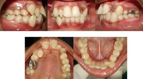 Orthodontic Management Of Ectopic Transposed Agenesis And Peg Lateral