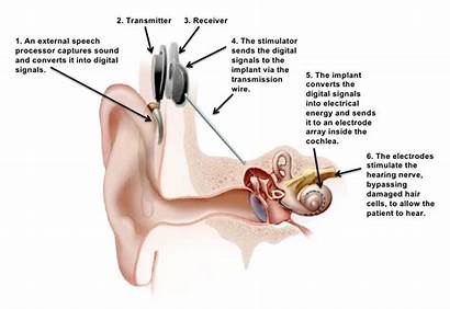 Cochlear Implant Diagram Stieglitz Christine August Cable
