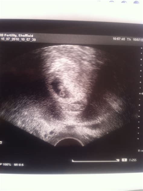 I had no choice on wen but luckily got an early scan, don't want to b too nieve and relax as last… The Baby Making Files: Over the moon and jumping for joy :)