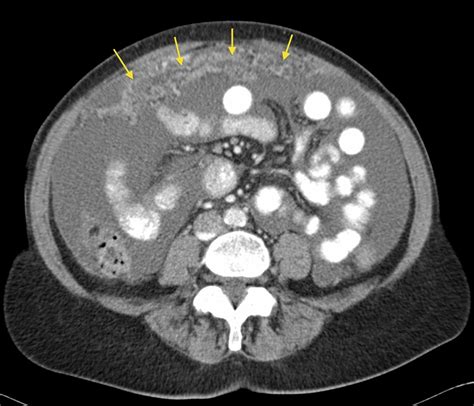 Peritoneal Carcinomatosis Radiology At St Vincents University Hospital