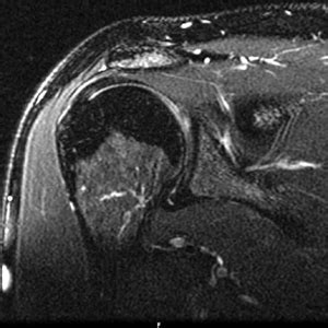 Basic Shoulder Mri