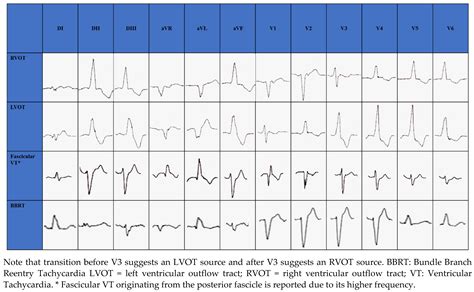 JCM | Free Full-Text | Flecainide in Ventricular Arrhythmias: From Old