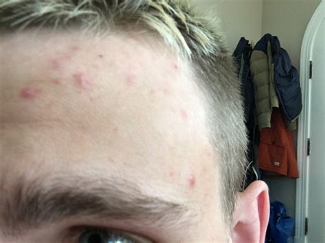 Adult Forehead Acne General Acne Discussion Forum