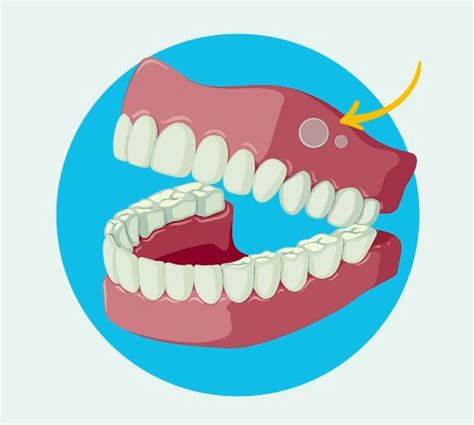 Cómo Prevenir El Vph En Lesiones Bucales Directorio Odontológico