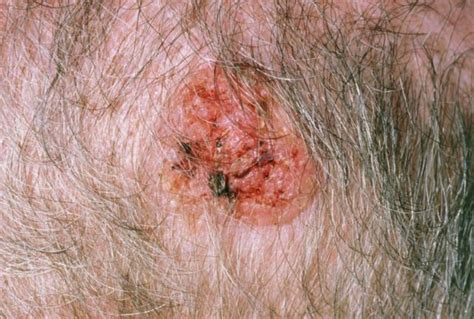 Squamous Cell Carcinoma Classification Improved With Ajcc8 Revision
