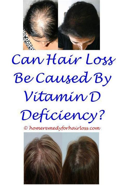 How To Stop Hair Loss Due To Lupus