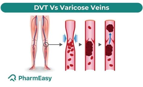 Difference Between Dvt And Varicose Veins Pharmeasy Blog