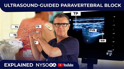 Ultrasound Guided Paravertebral Block Youtube
