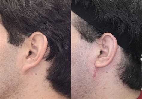 Before And After Otoplastymacrotia Procedures In Coral Gables Fl Jose