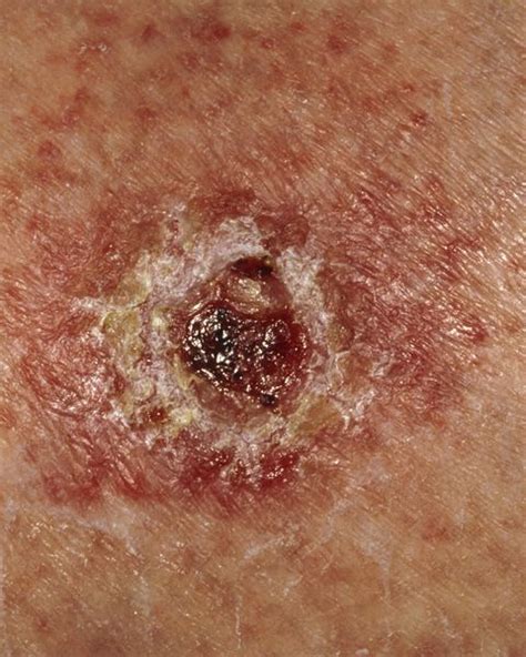 The 5 Types Of Skin Cancer Skin Cancer Pictures
