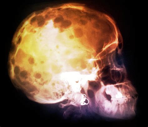 Bone Cancer Of The Skull Photograph By Zephyrscience Photo Library