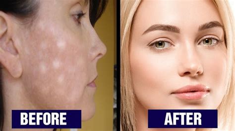 5 Ways To Get Rid Of White Spots On Face In 2023 Spots On Face White