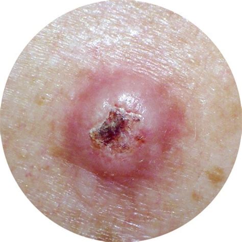Skin Cancer Types Symptoms Causes And Prevention