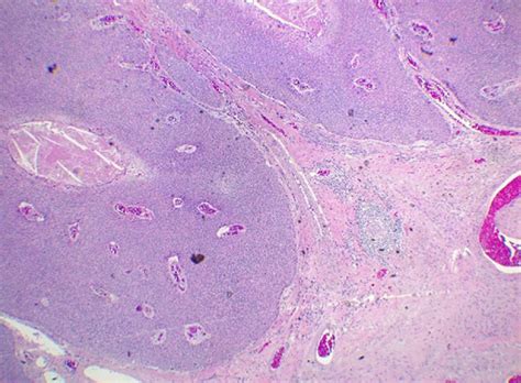 Eccrine Porocarcinoma With Mitosis And Prominent Nucleoli Seen At 40x