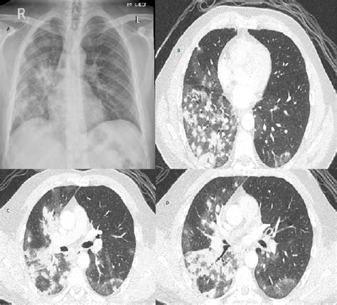 1a Chest X Ray Image Showing Inhomogeneous Patchy Infiltrates In The