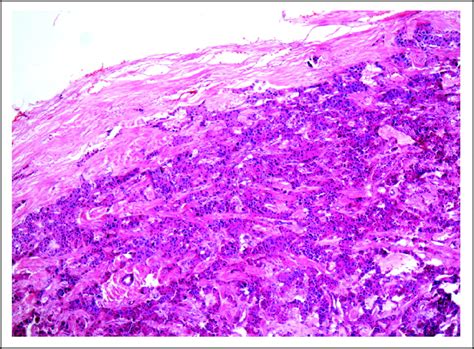 Necrolytic Migratory Erythema Associated With Glucagonoma Syndrome