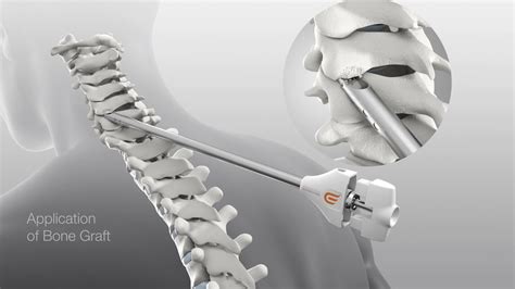 Posterior Cervical Fusion With Dtrax® Spinal System Youtube