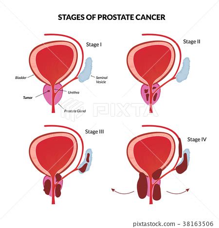 Four Stages Of Prostate Cancer Stock Illustration Pixta