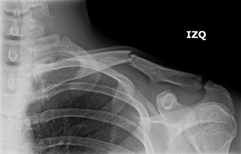 Clavicle Fractures Causes Symptoms Treatments Total Orthopedics