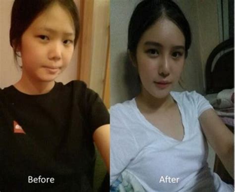 81 Photos Of Plastic Surgery In Korea That Will Make Your