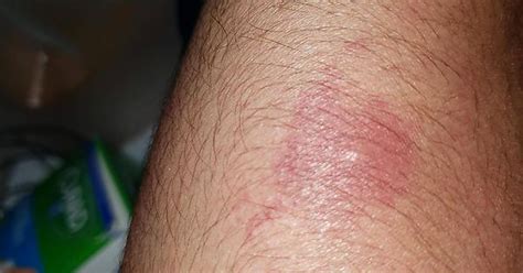 Red Rashes On Arm Had Something Bite Me A Couple Of Weeks Ago But They