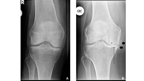 Osteophytic Lipping Knee Pain
