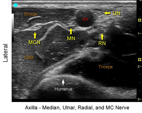 Musculocutaneous Nerve Brachial Plexus