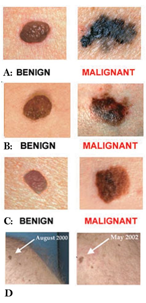 Checking Your Moles Remember The Abcde Rule Vrogue Co