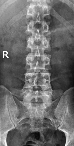Ap Lumbar Spine X Ray Diagram Quizlet