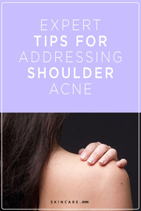 11 Easy Tips For Preventing And Getting Rid Of Shoulder Acne Skincare
