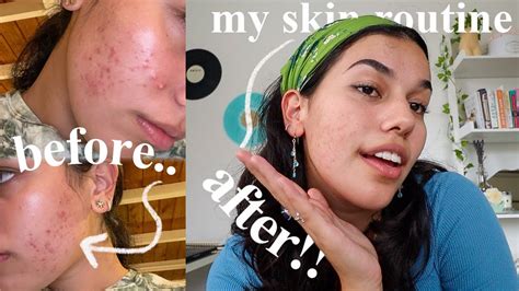 How I Cleared My Acne Skincare Routine And Tips Youtube