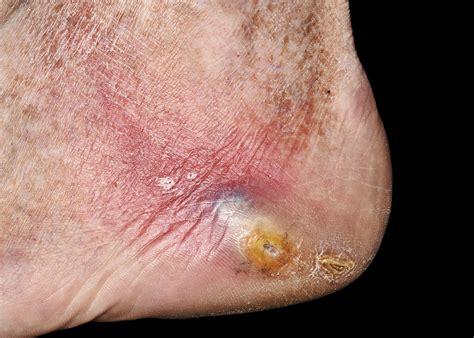 Prevention And Treatment Of Diabetic Foot Ulcers May Benefit From