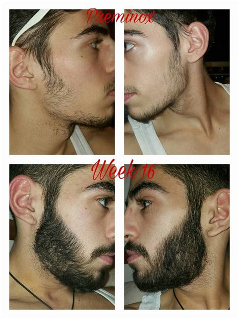 Before and after photos from real minoxidil products user: Grow your beard and treat baldness... - Kirkland 5% ...