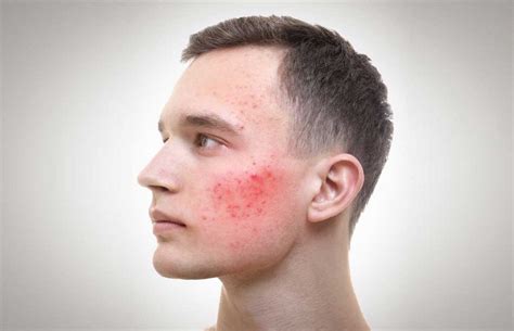Male Acne Treatment Carlisle Fast Long Lasting Results Vl Aesthetics