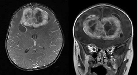 Isolated Intracranial Rosai Dorfman Disease In A Child American