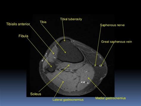 Knee Muscle Anatomy Mri Mri Knee Joint Anatomy On Anatomical Parts