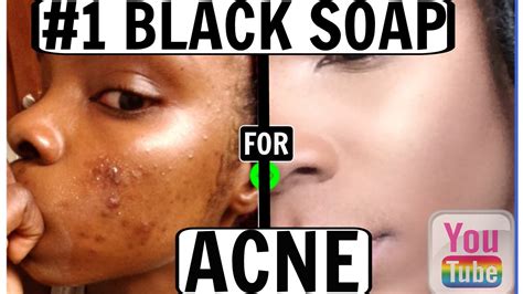 The 1 Best Black Soap For Acne Before And After Fairrah♡ Youtube