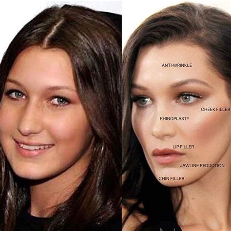 love this transformation bella hadid what do you think comment 👇 beautiful botox brow lift