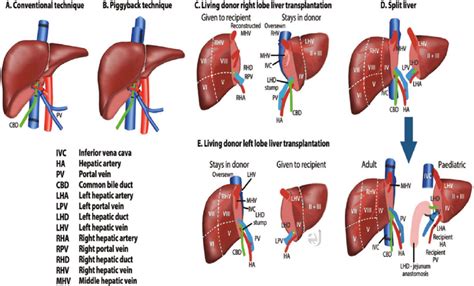 Available Surgical Techniques For Liver Transplantation A