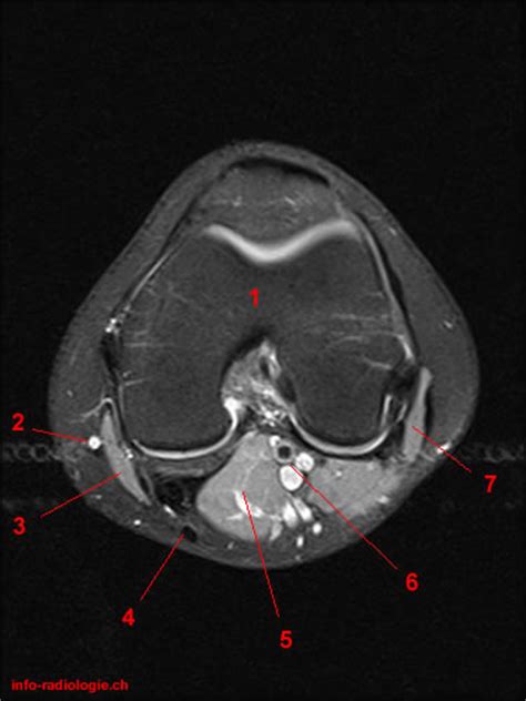 Any tightness or weakness in the muscles around the knee makes you prone. Knee Muscle Anatomy Mri - Mri Image Of Left Knee Of A 21 Year Old Patient With Intra Operative ...