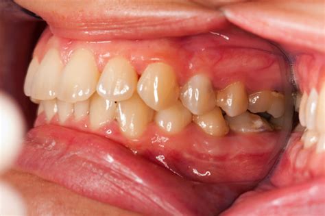 Swollen Gums Causes Trusted Health Products