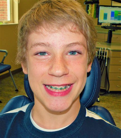 Pin By John Beeson On Guys In Braces Guys With Braces Orthodontic Treatment Orthodontics